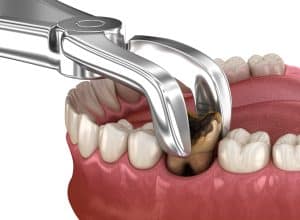 tooth extraction in Winston-Salem