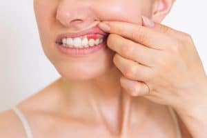 a close-up photo of a young Caucasian woman who shows off her red gums on the upper jaw, suffers from gum inflammation