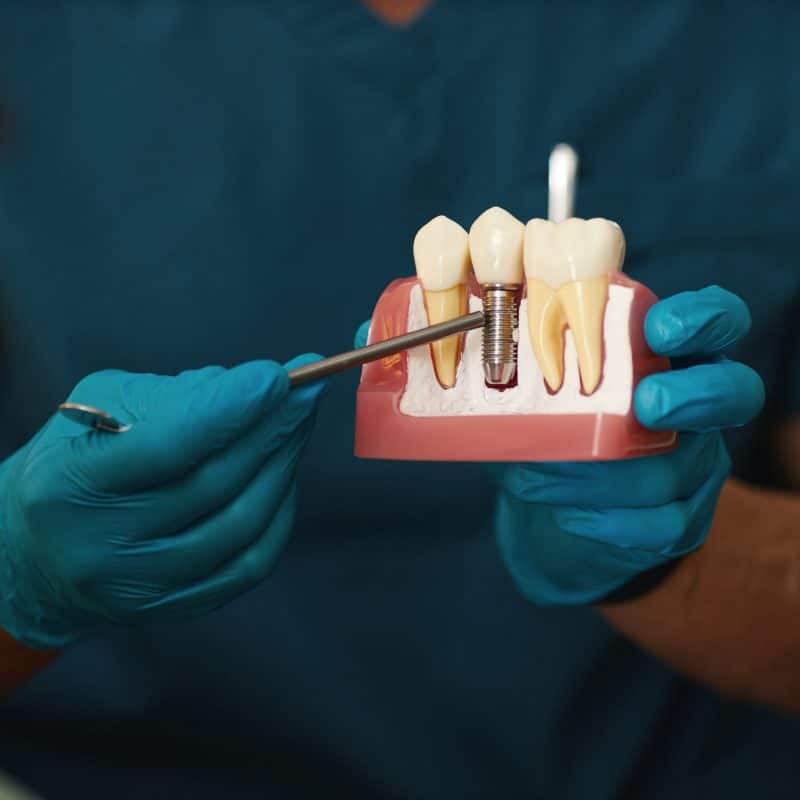 dentist using a model to show how your dental implant will attach to your jaw bone
