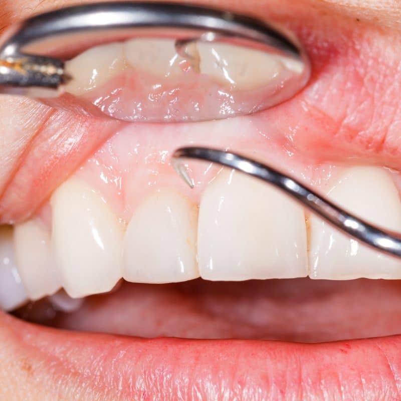 Periodic dental examination showing a healthy mouth and teeth