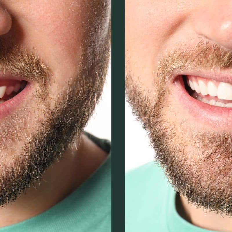 side by side of a gummy smile fixed by laser dentistry