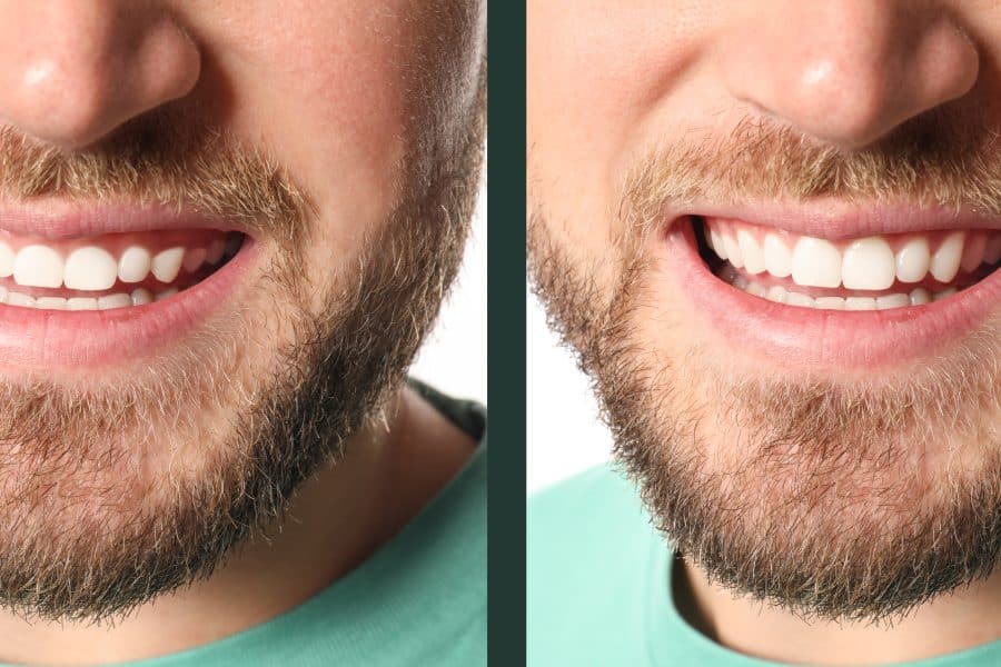 side by side of a gummy smile fixed by laser dentistry
