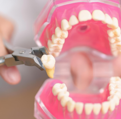 Winston Salem Dental Specialists -Tooth Extractions in Winston Salem, NC
